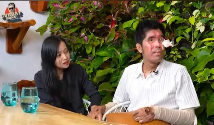 agus korban penyiraman air keras(suara.com)